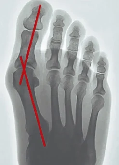 epitact Korrekturorthese Hallux-Valgus